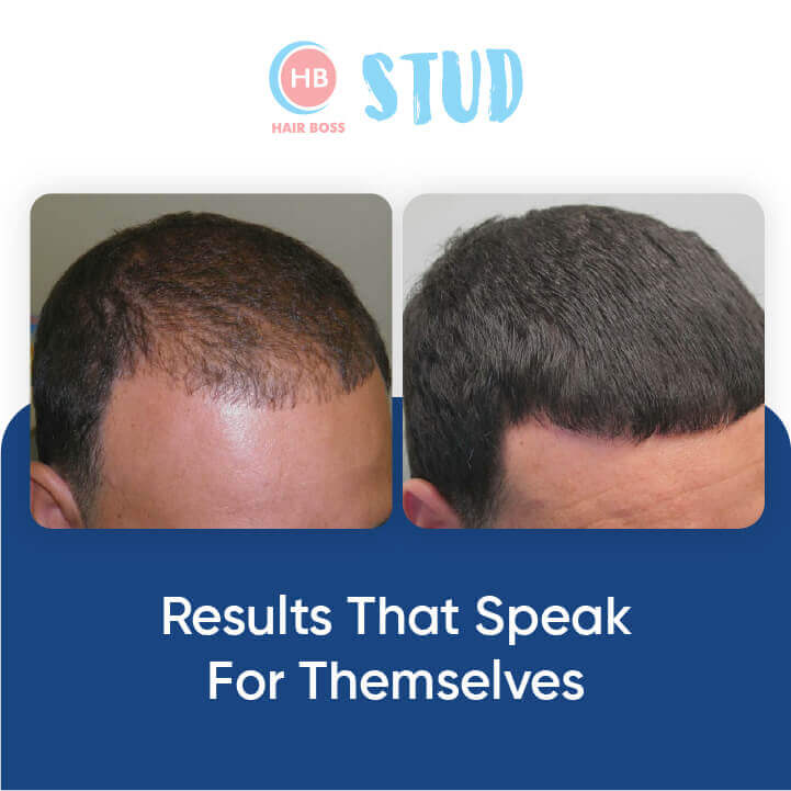 Best Hair Growth Products in South Africa 2026